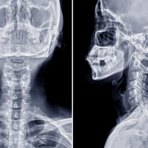 RAIO-X DA COLUNA CERVICAL – AVALIAÇÃO DA SAÚDE DA SUA COLUNA