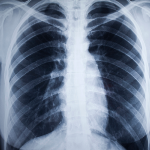 RAIO-X DO TÓRAX – AVALIAÇÃO DA SAÚDE PULMONAR E CARDÍACA