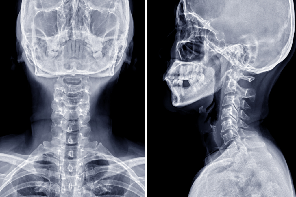 RAIO-X DA COLUNA CERVICAL